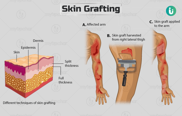 Skin Grafting